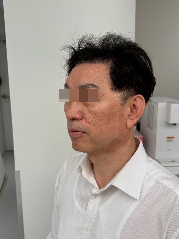 Ultra Clear Laser Coring Review – My Recovery Journey