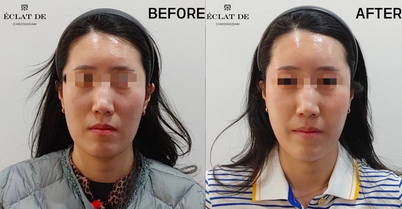 Thermage FLX 300 Shots- Before & After from Eclat De