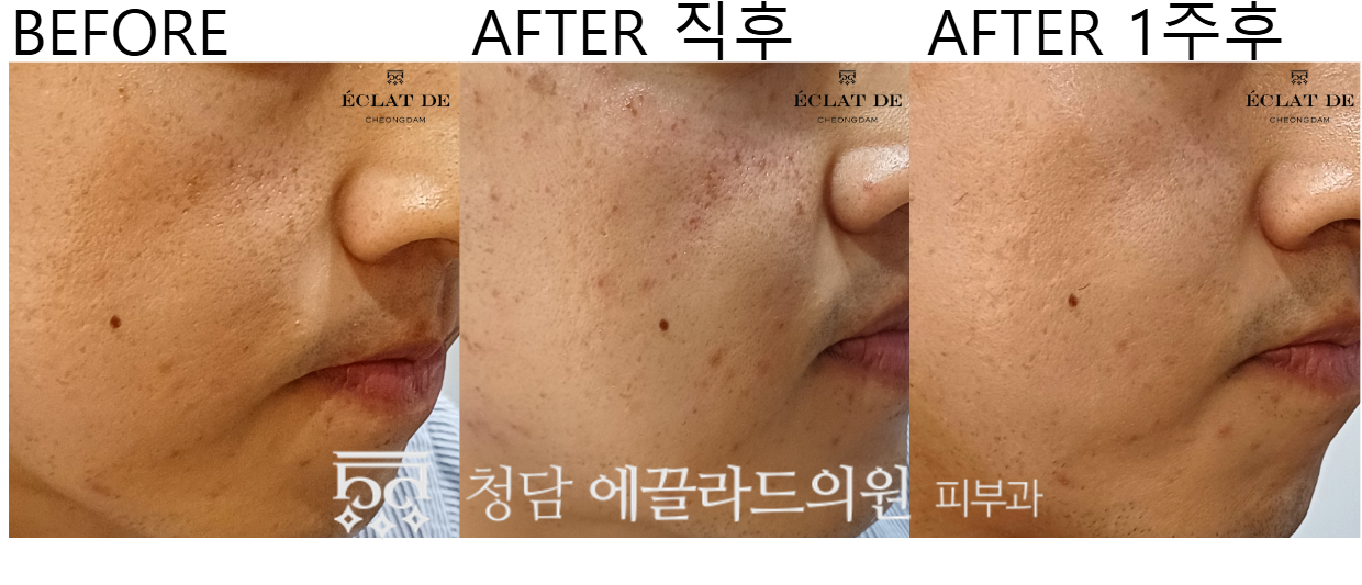 Res Novae & Clarity Pigmentation Treatment– Before & After from Eclat De