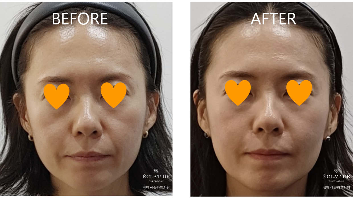 Ellisys Sense + Ultherapy – Before & After from Eclat De