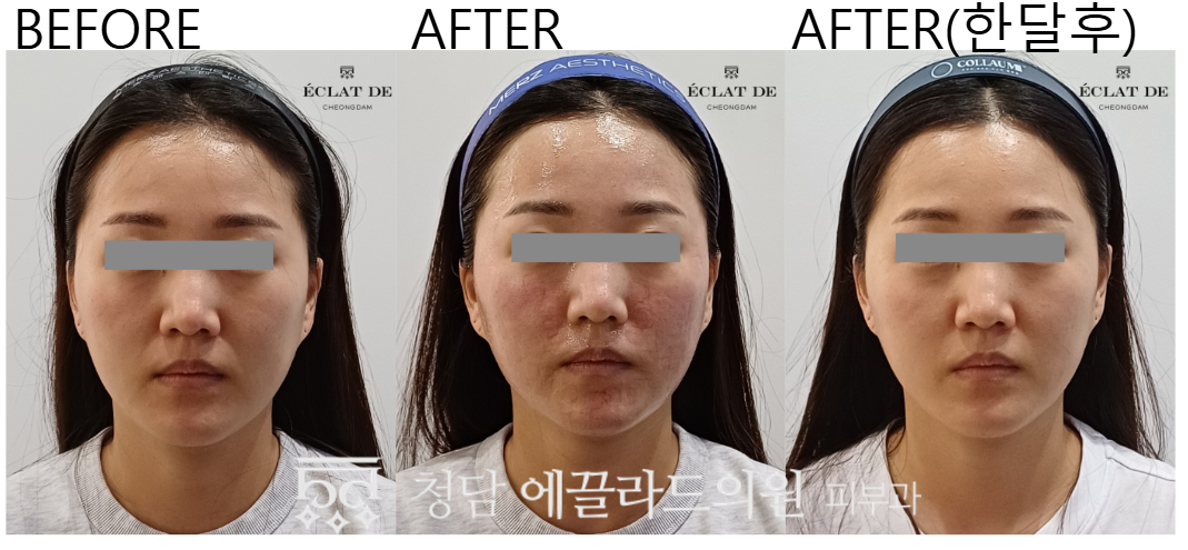 Ellisys Sense – Before & After from Eclat De