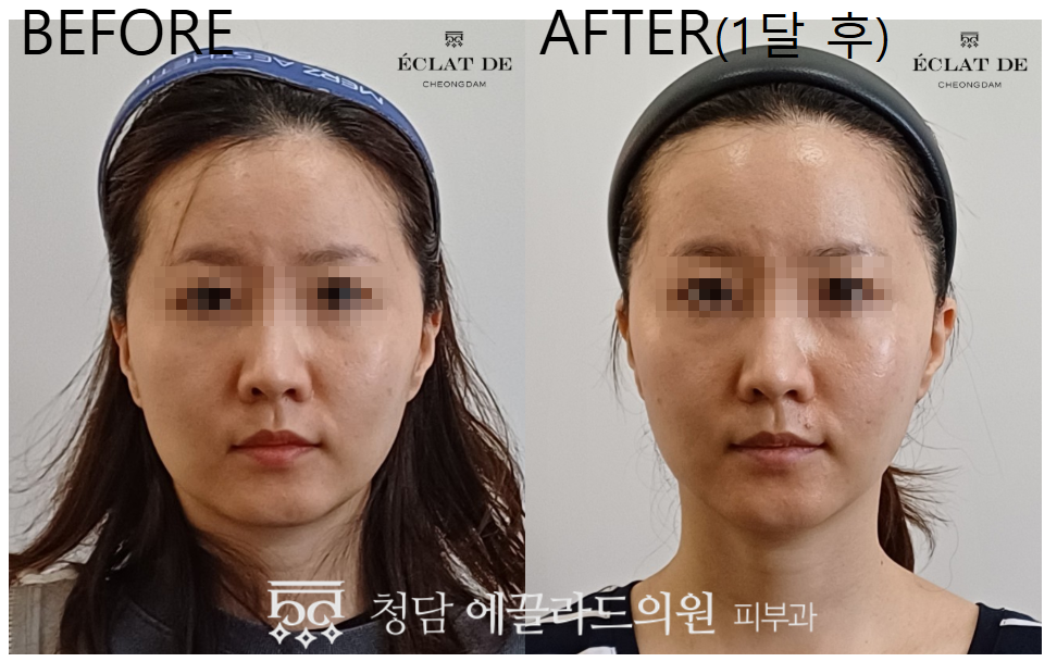 Titanium Lifting 80KJ – Before & After from Eclat De