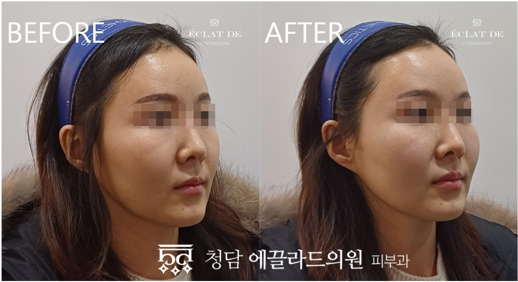 Titanium Lifting 80KJ – Before & After from Eclat De