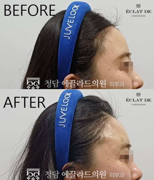 Forehead Filler, Forehead Botox, and Glabella Botox- Before & After from Eclat de