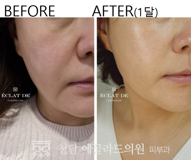 ONDA FACE- Before & After from Eclat de