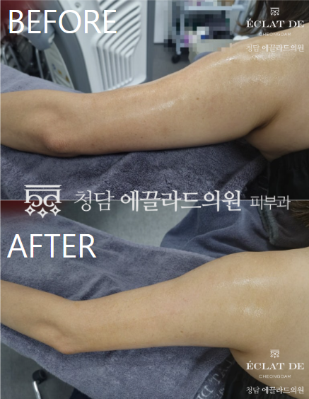 ONDA Body – Before & After from Eclat De