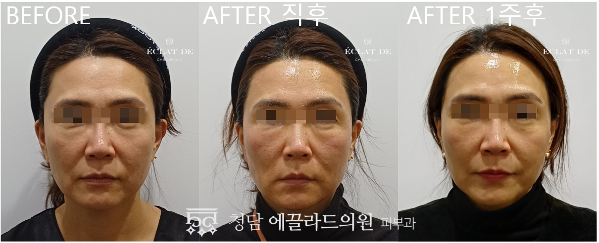 UltraClear- Before & After from Eclat De
