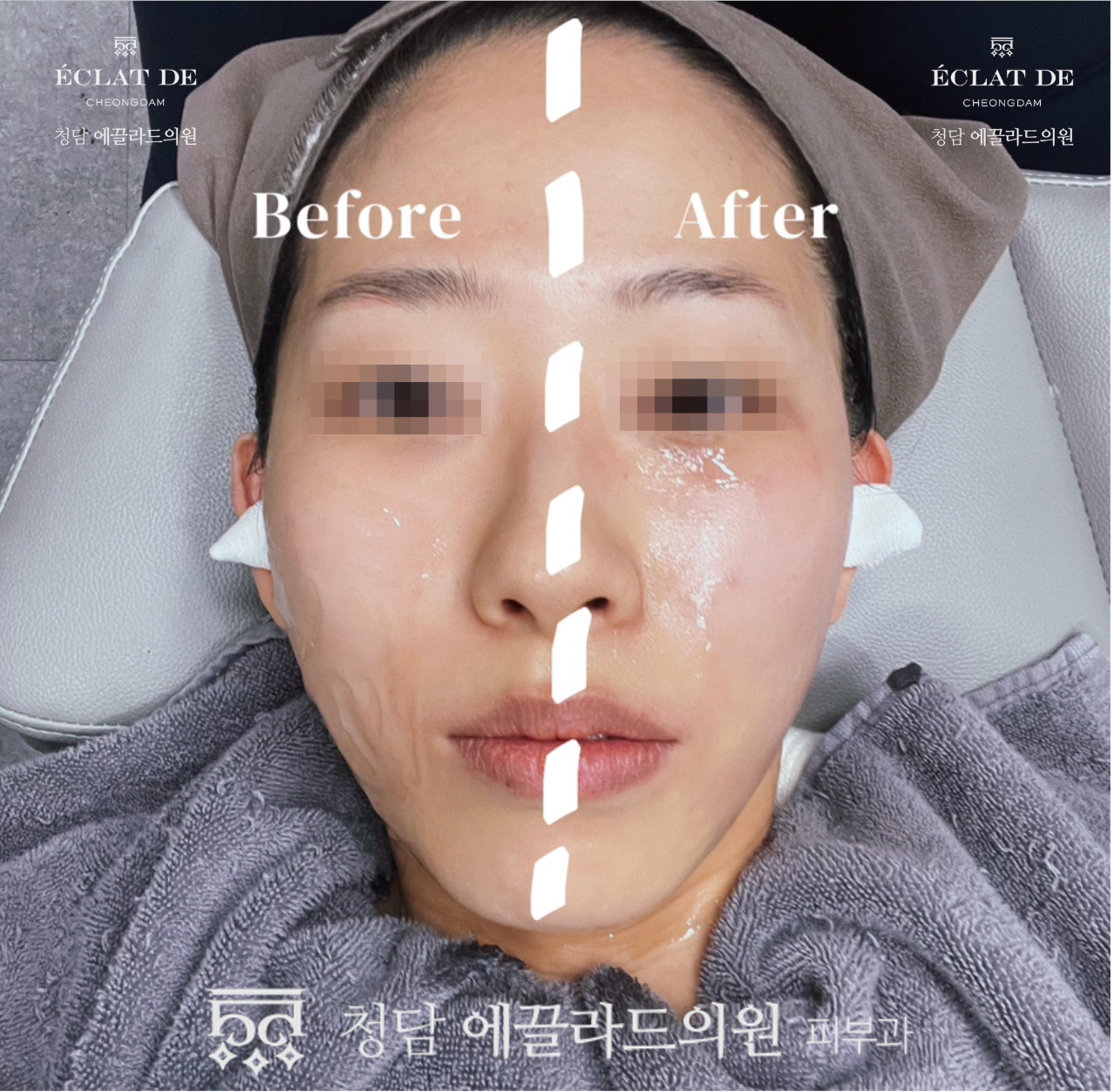 Thermage FLX 300 Shots- Before & After from Eclat De
