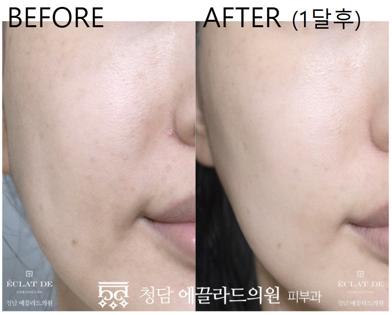 Rejuran Healer  – Before & After from Eclat De